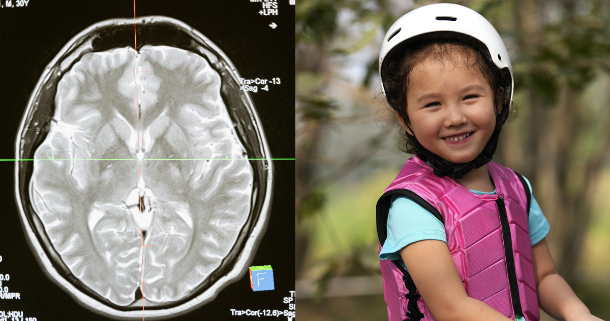 radiografía cerebral (izquierda) y fotografía de Rylae-Ann Poulin, niña que volvió a caminar tras terapia genética intracerebral