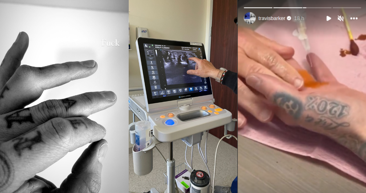 Stories de Travis Barker mostrando su dedo quebrado