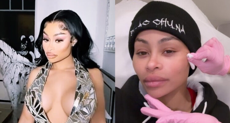 Blac Chyna antes y después del proceso en el que está eliminando sus rellenos faciales.