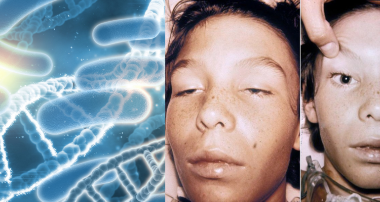 Ilustración de bacterias (izquierda) y niño con síntomas de botulismo (derecha) en referencia a alza de casos en Turquía