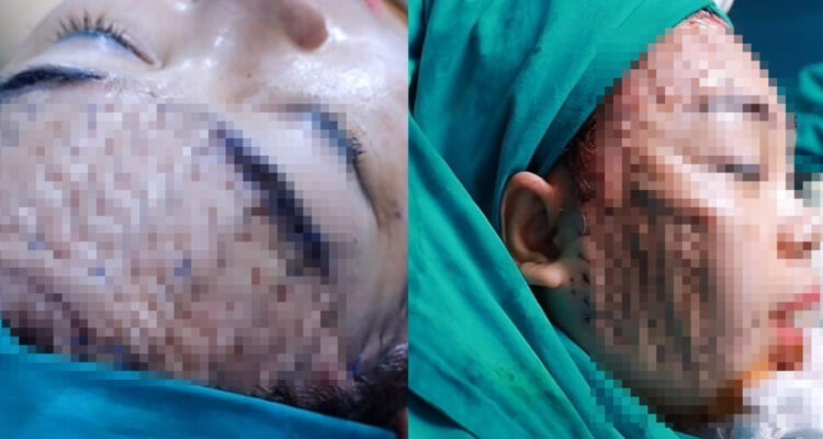 ¿Qué es la cirugía de estiramiento facial “telaraña”?