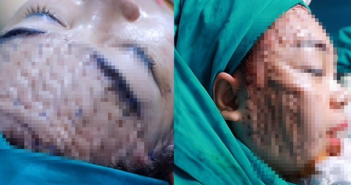 ¿Qué es la cirugía de estiramiento facial “telaraña”?