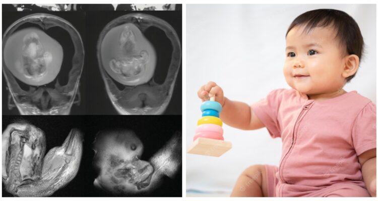 Capturas del cráneo con el feto aún integrado, y una imagen de contexto de una niña china.