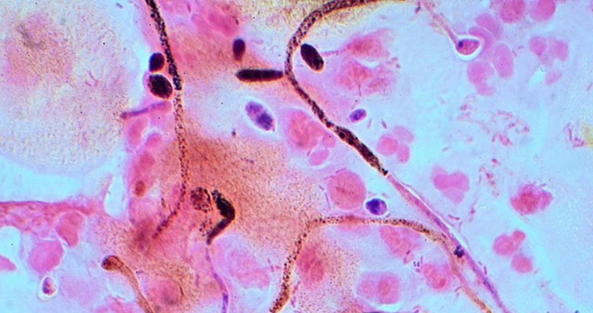 Imagen de una variante del hongo Candida. La especie Cándida auris levantó alertas en Estados Unidos por el aumento de casos con el contagio del hongo potencialmente mortal.