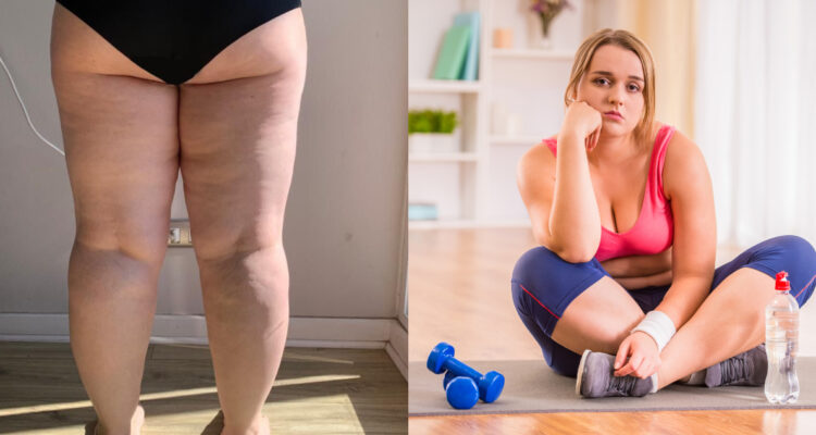 Test permite saber si podrías sufrir lipedema