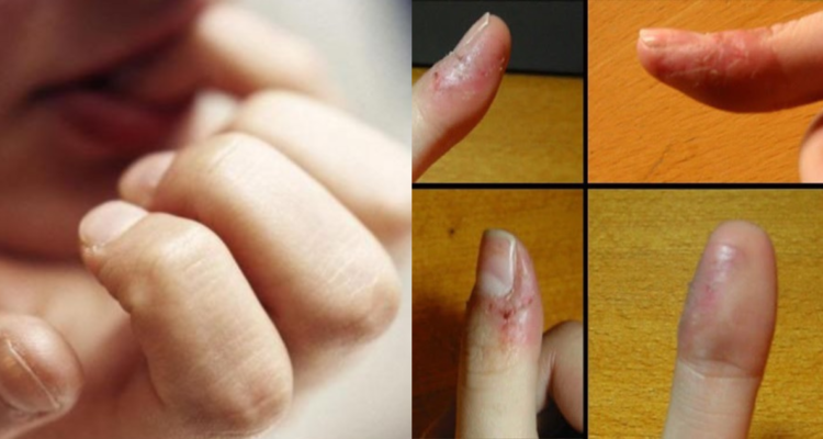 Mujer mordiendose las uñas (izquierda) y persona con los dedos lesionados (derecha) por dermatofagia