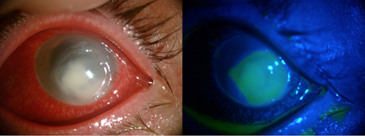 Pseudomonas Aeruginosa en ojos, causada por las gotas mortales de la India, comercializadas en EEUU por EzriCare