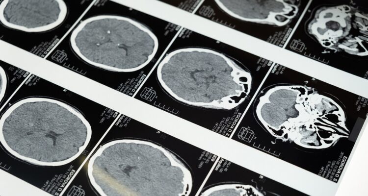 Fotografía de contexto, radiografías de un cerebro.