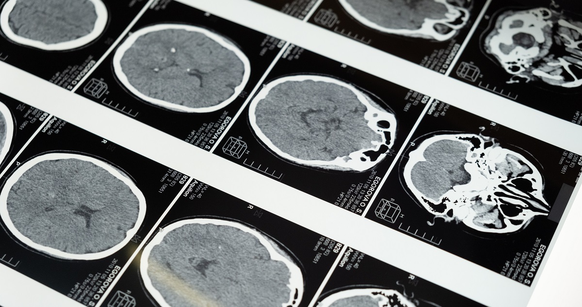 Fotografía de contexto, radiografías de un cerebro.