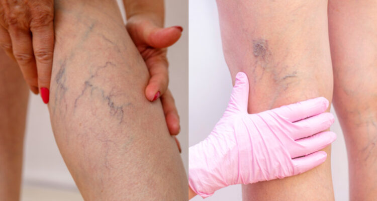 La compresión graduada podría retardar la aparición de várices