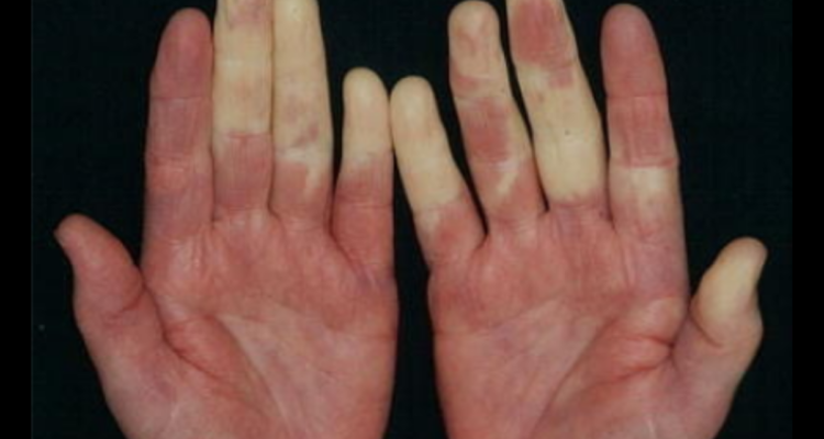 Ejemplo de manos con Síndrome de Raynaud