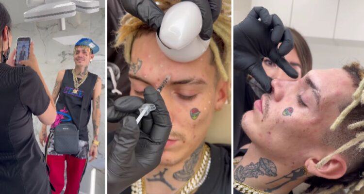 Video muestra a Marcianeke enchulándose con procedimiento estético facial