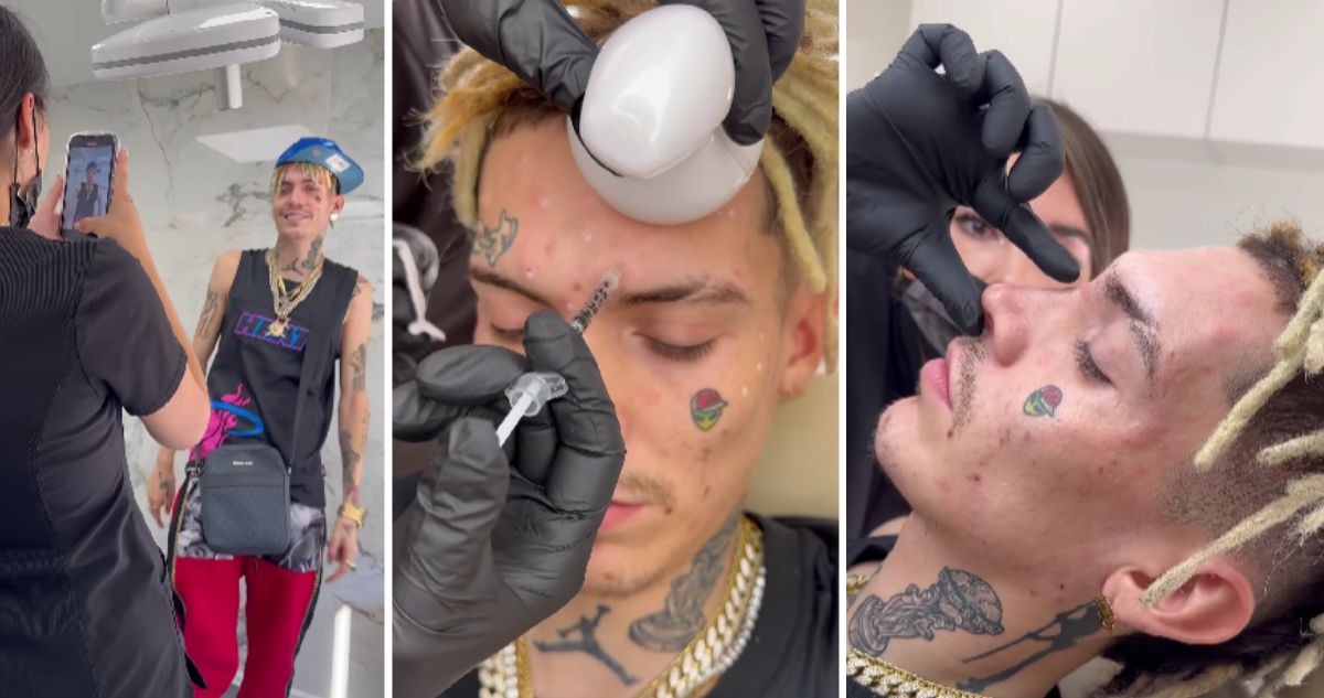 Video muestra a Marcianeke enchulándose con procedimiento estético facial