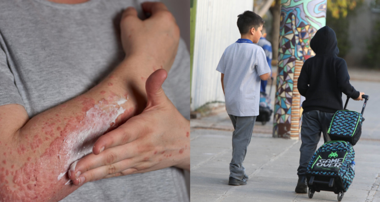 Persona aplicandose crema para sarpullido provocado por sarna (izquierda) y fotografía de escolares (derecha)