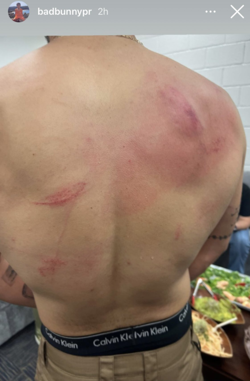 La espalda de Bad Bunny, tras su pelea en la WWE.