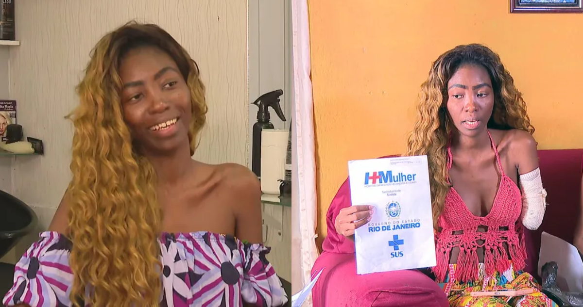Alessandra Dos Santos, bailarina brasileña que terminó con un brazo amputado tras operación por miomas