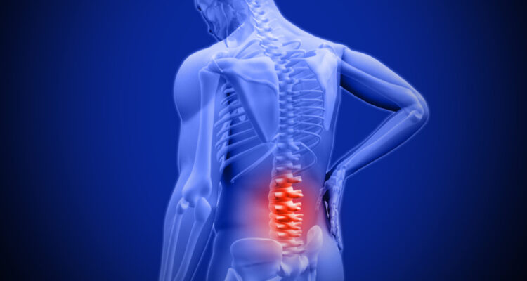 Una gráfica sobre el dolor de espalda baja.