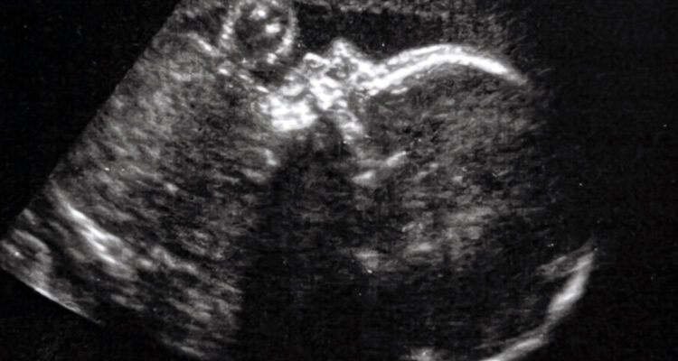 Cirujanos lograron un avance prometedor al conseguir operar el cerebro de un feto mientras éste estaba aún en el útero, consiguiendo aparentemente revertir una condición prenatal que pudo haberle causado daños severos tras nacer, o incluso la muerte.