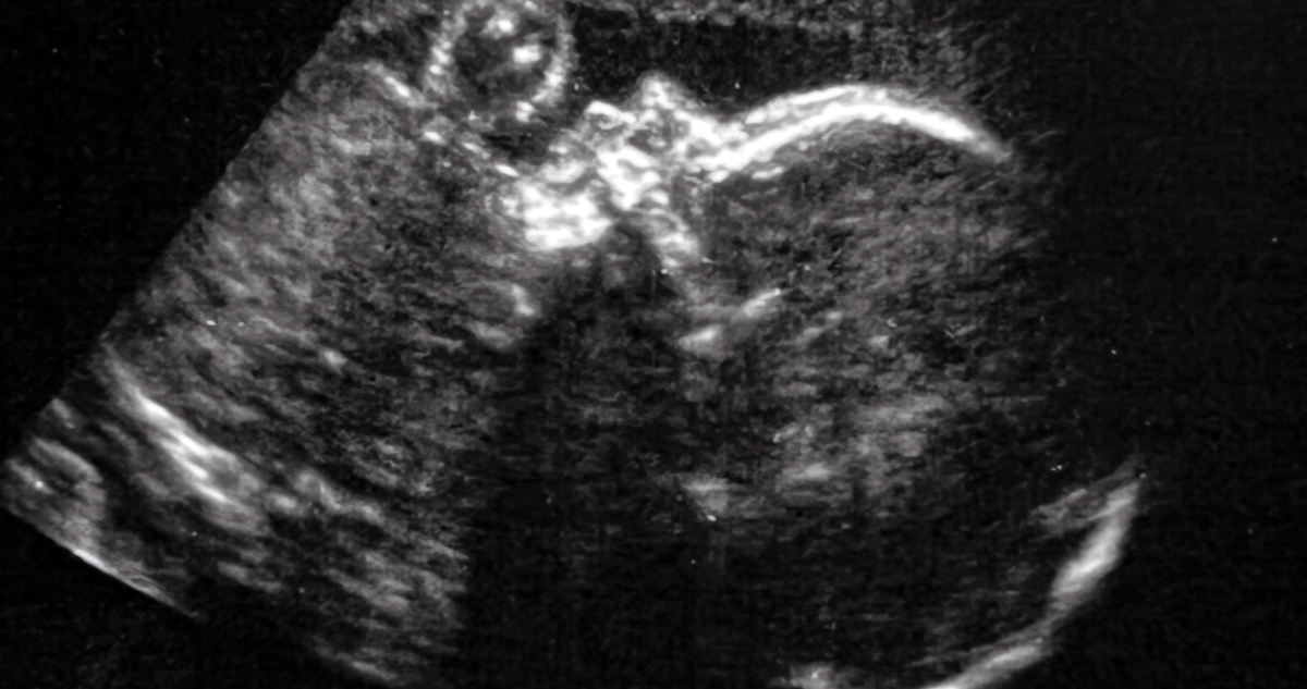 Cirujanos lograron un avance prometedor al conseguir operar el cerebro de un feto mientras éste estaba aún en el útero, consiguiendo aparentemente revertir una condición prenatal que pudo haberle causado daños severos tras nacer, o incluso la muerte.