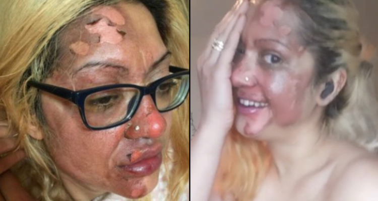 Influencer cara quemada por huevo