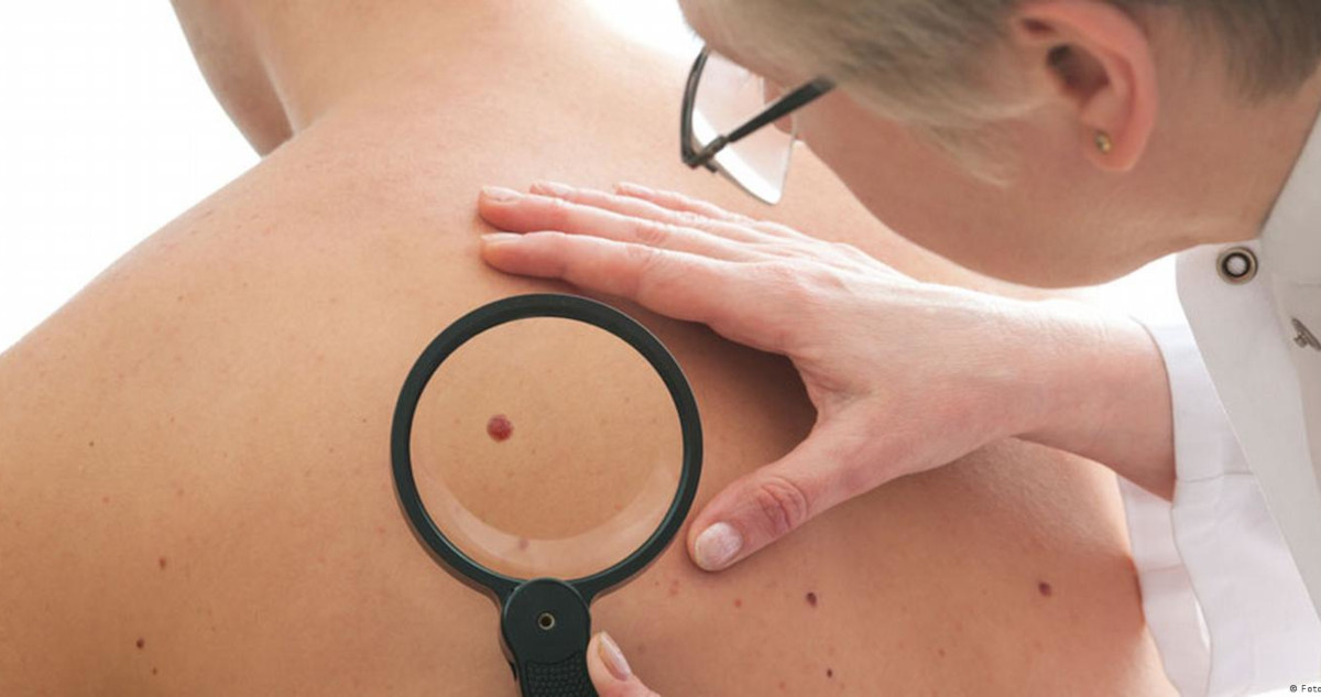El melanoma es el tipo de cáncer de piel más grave.