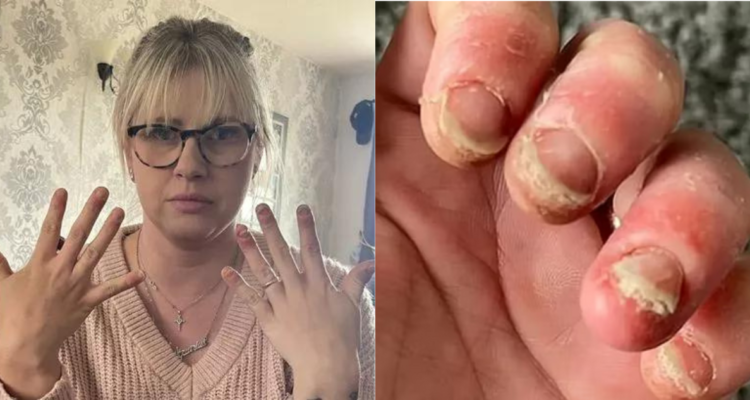 Reacción en uñas a manicura