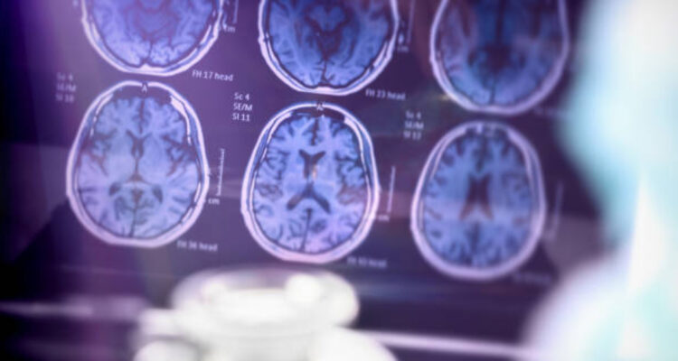 Científicos chilenos intentan anticipar el riesgo de Alzheimer con Inteligencia Artificial (IA)