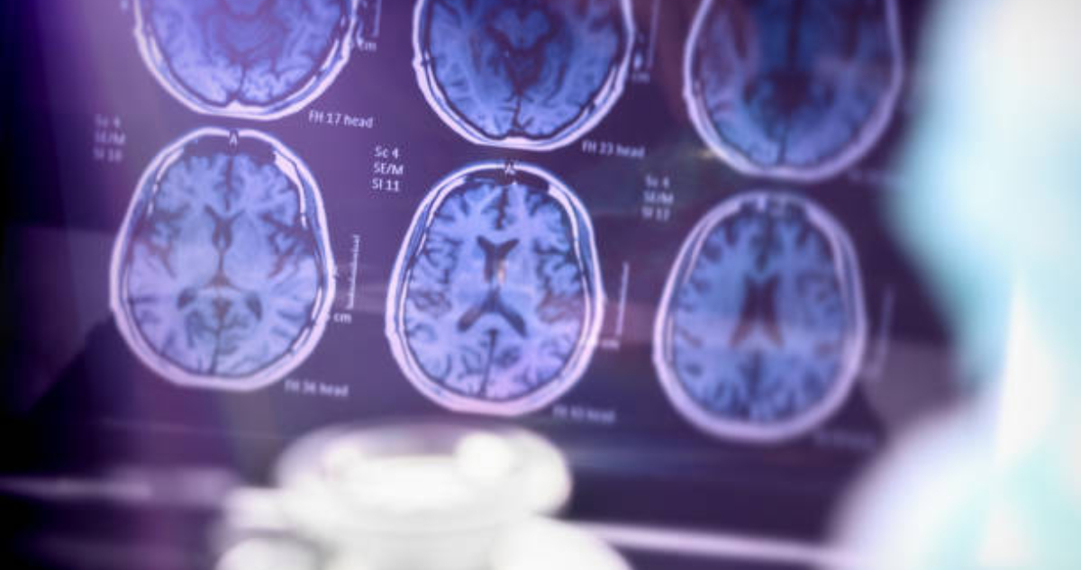 Científicos chilenos intentan anticipar el riesgo de Alzheimer con Inteligencia Artificial (IA)