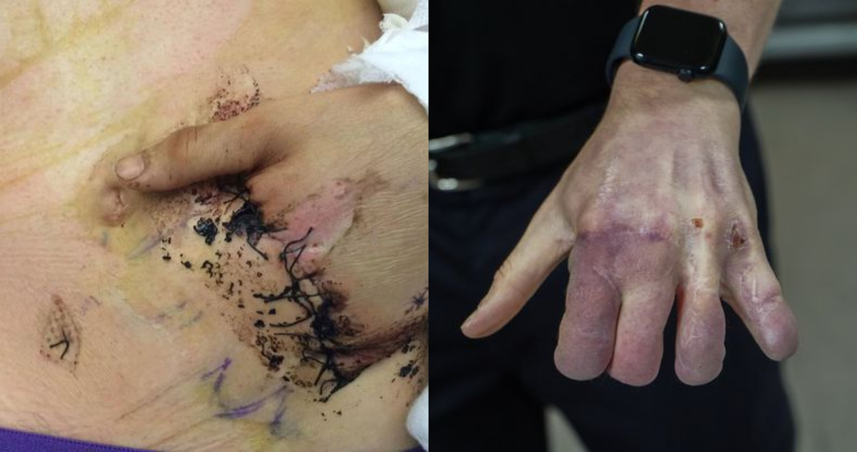 Inusual procedimiento realizado a bombero británico para salvar su mano