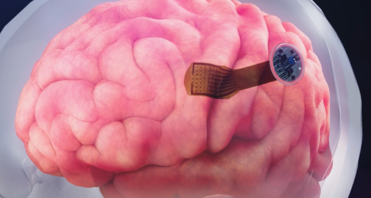 La compañía Precision Neuroscience ya está probando chips en los cerebros de voluntarios, manteniéndolos por 15 minutos para hacer pruebas y luego retirarlos.