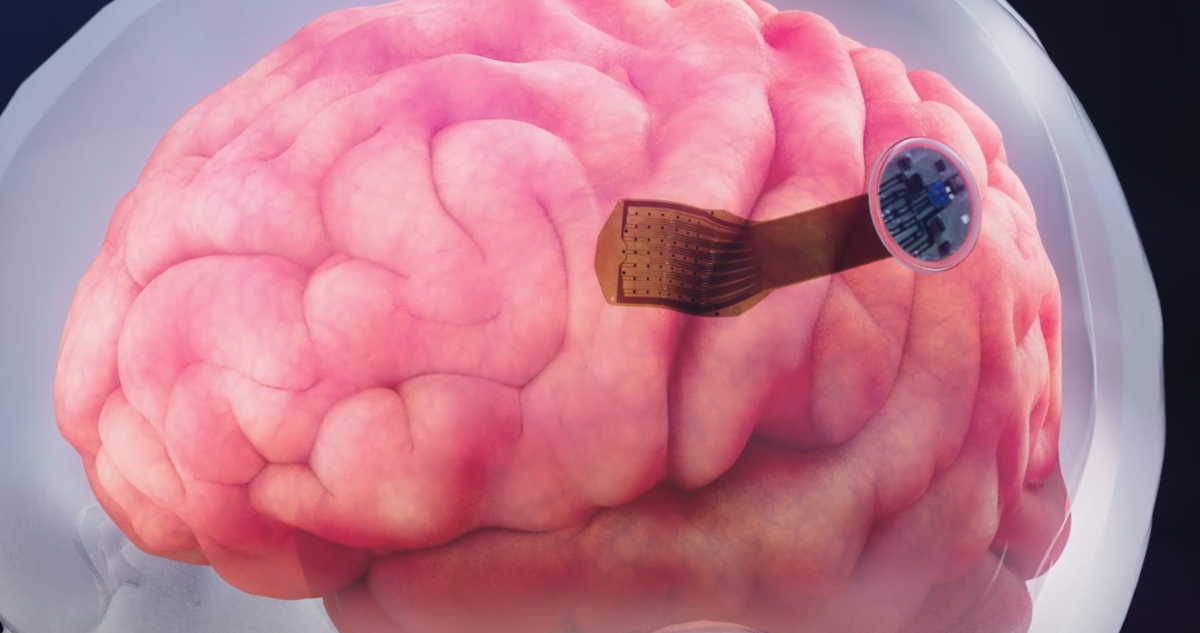 La compañía Precision Neuroscience ya está probando chips en los cerebros de voluntarios, manteniéndolos por 15 minutos para hacer pruebas y luego retirarlos.