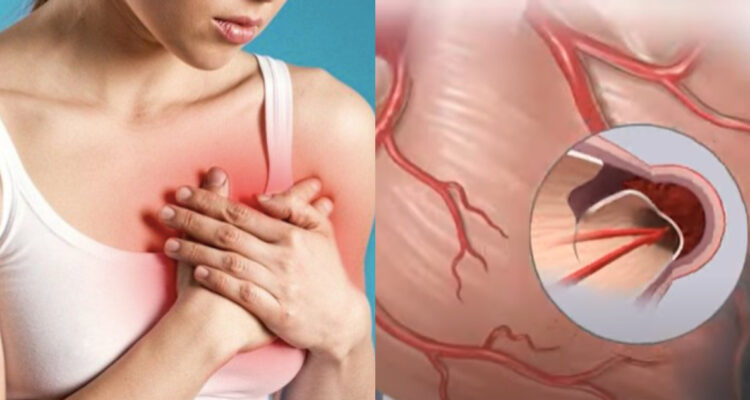 Disección espontánea de la arteria coronaria