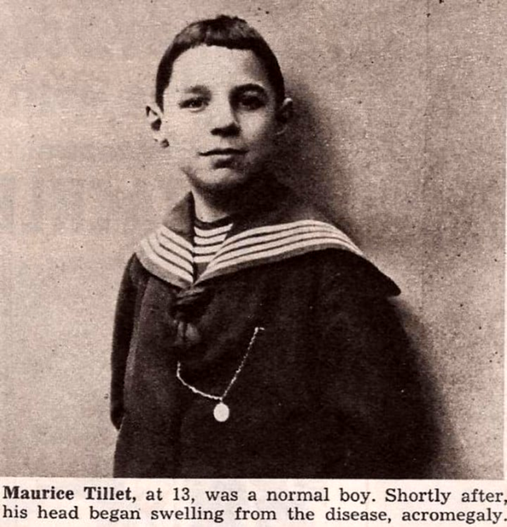 Maurice Tillet, nacido en Francia, tuvo una infancia normal, antes de la acromegalia