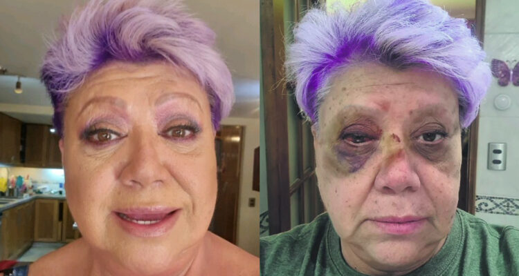 Patricia Maldonado antes y después de accidente.