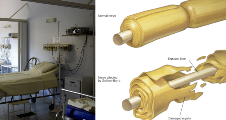 Brote del Síndrome Guillian Barré en Perú: ¿Es una preocupación en Chile?