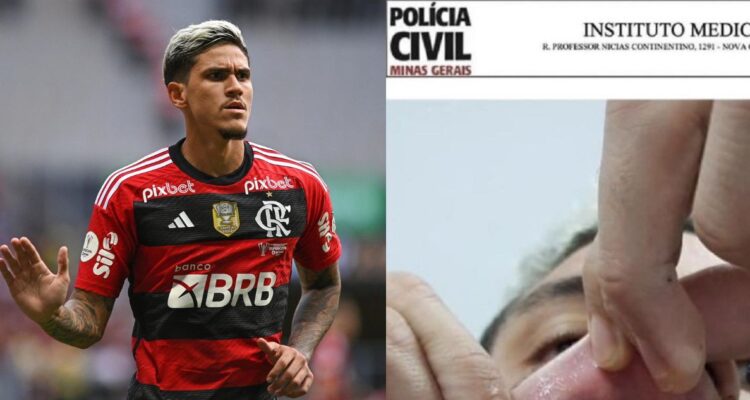 Pedro y la foto de la herida en su boca tras ser agredido por PF del Flamengo