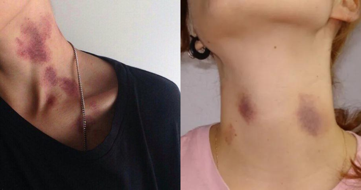 Riesgo de chupones