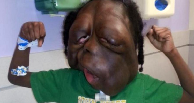 “Eres un monstruo”: el cruel bullying contra Amare Stover por gigantesco tumor en su rostro