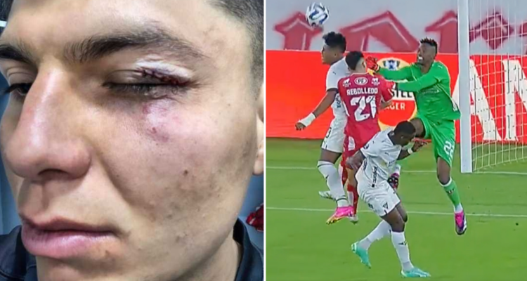 El rostro de Raimundo Rebolledo tras feroz golpe de portero de LDU.