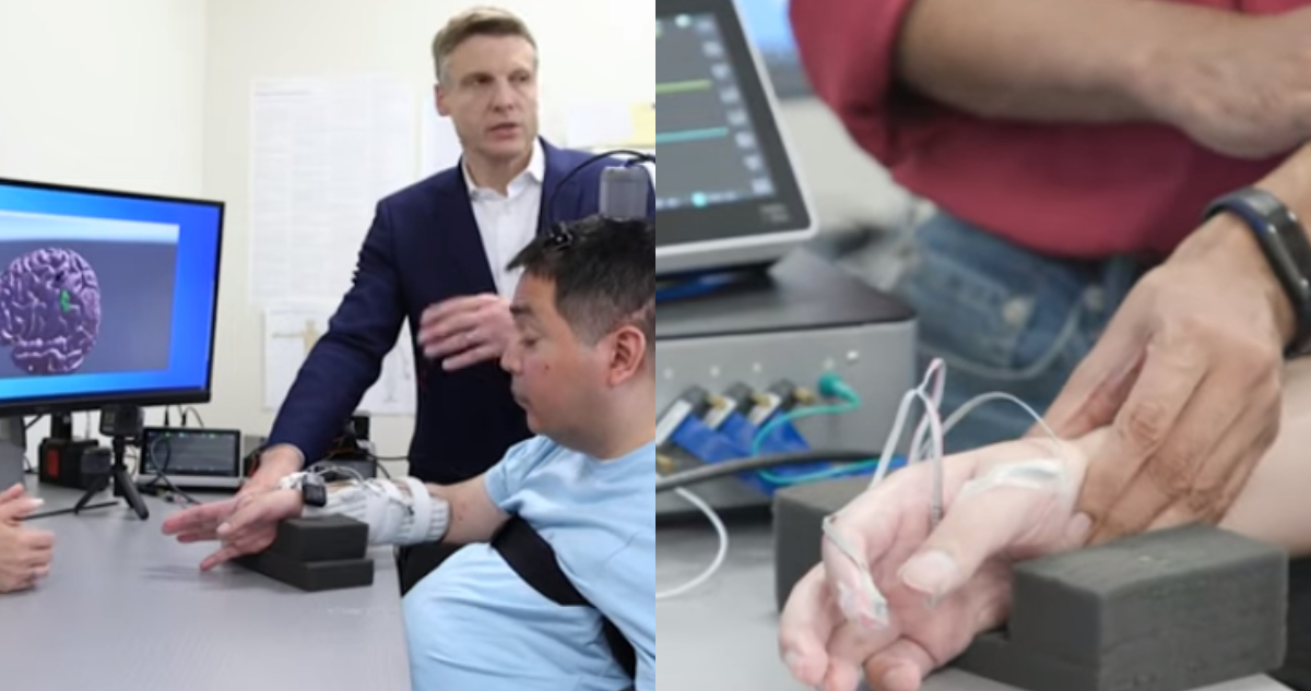 Restablecen parcialmente la movilidad de un hombre tetrapléjico mediante microchips cerebrales con IA