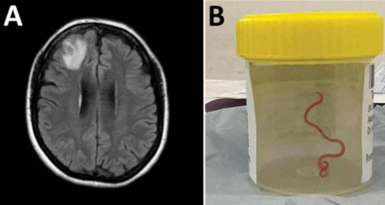 Es el primer caso en humanos: extraen lombriz intestinal viva de 8 centímetros desde cerebro de mujer