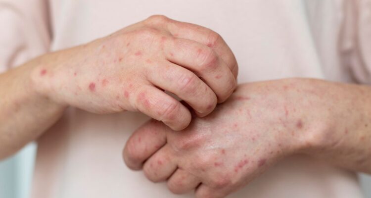 Se conoció un caso de sarampión importado en Chile