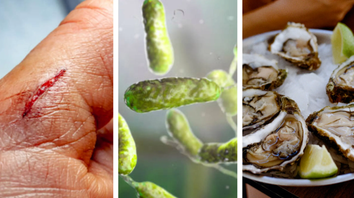 Bacteria Vibrio Vulnificus se encuentra en pescados contaminados, como tilapias y ostras. Persiste en temperaturas cálidas y de alta salinidad