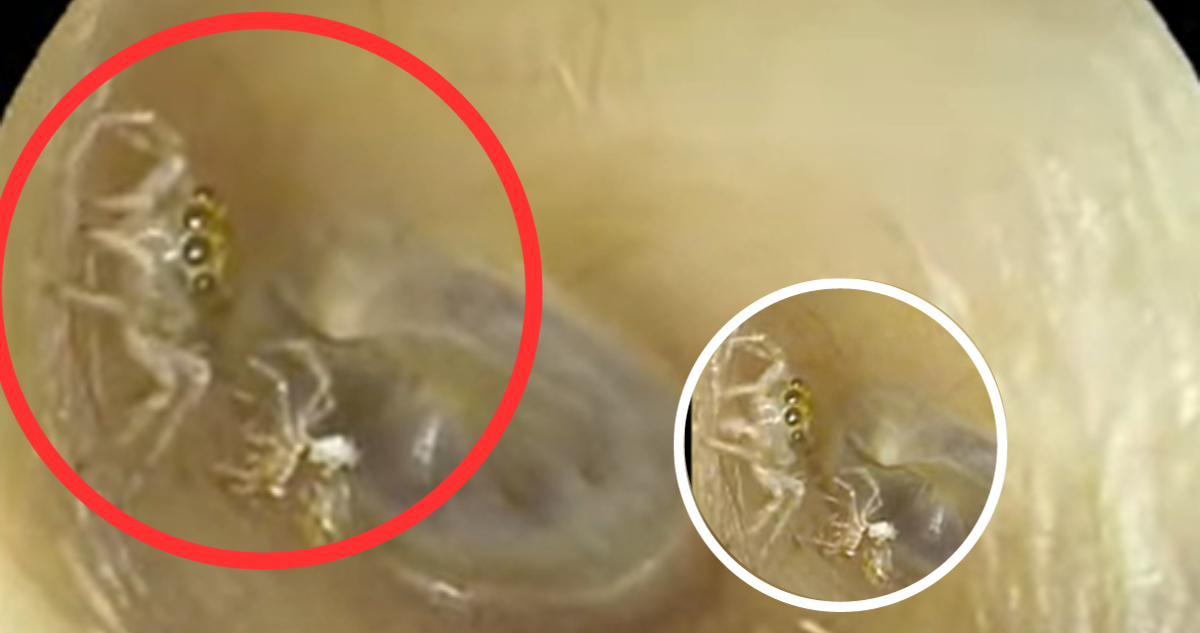 El escalofriante video de una araña al interior del oído de una mujer en Taiwán