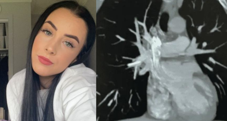 Dispositivo anticonceptivo migró hasta su corazón: Joven se percató luego de alarmantes síntomas