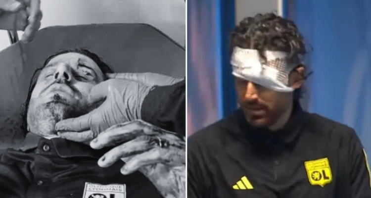 Fabio Grosso resultó ensangrentado tras ser apedreado en la previa del Clásico entre Lyon y Marsella.