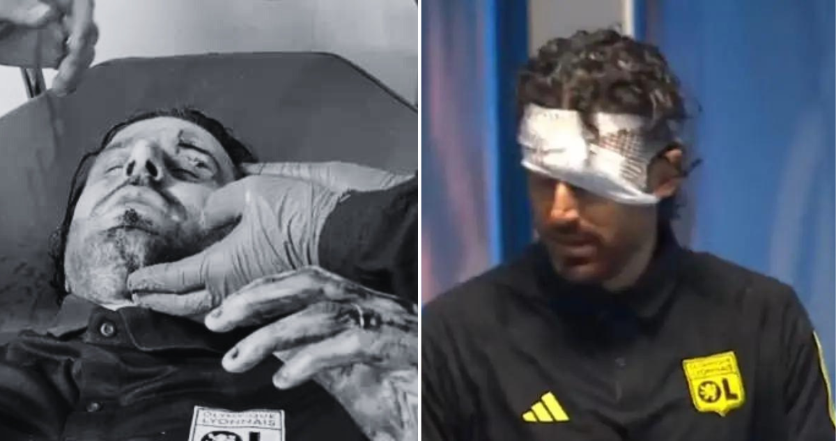Fabio Grosso resultó ensangrentado tras ser apedreado en la previa del Clásico entre Lyon y Marsella.