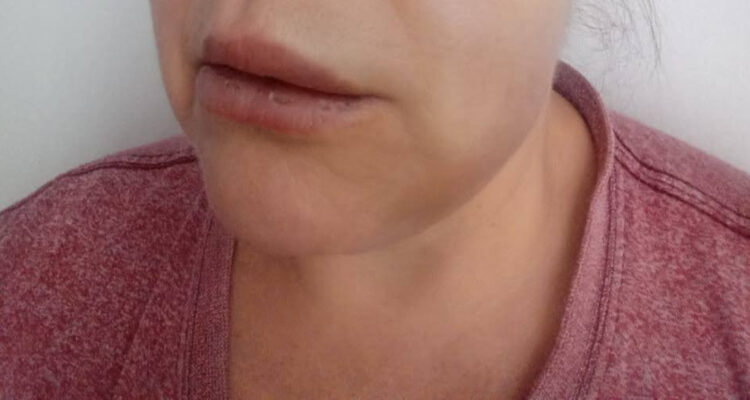 Paciente se querella contra clínica dental de Concepción: inyección generó parálisis y desfiguración