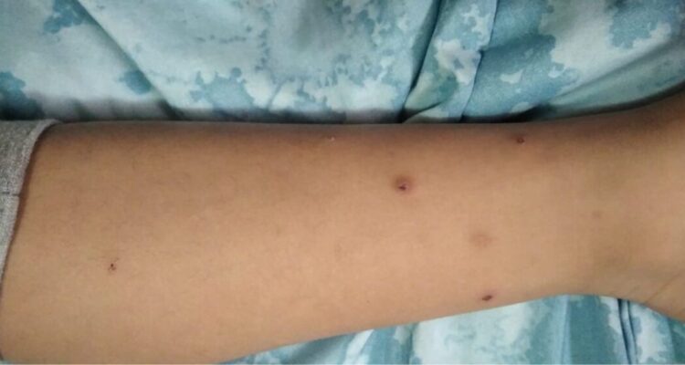 Apoderados y docentes denuncia contagio de sarna y tiña al interior de escuela en Antofagasta