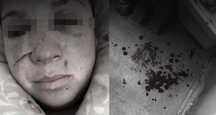 Chofer de transporte público denuncia ataque transfóbico en Peñalolén: resultó con la nariz fracturada